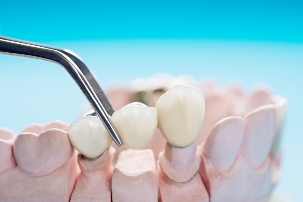 Dental Bridge in Sahuarita, Arizona