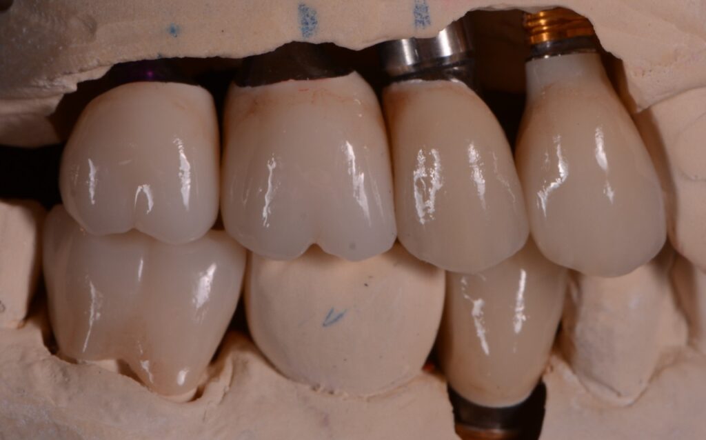 Missing Teeth in Sahuarita, Arizona