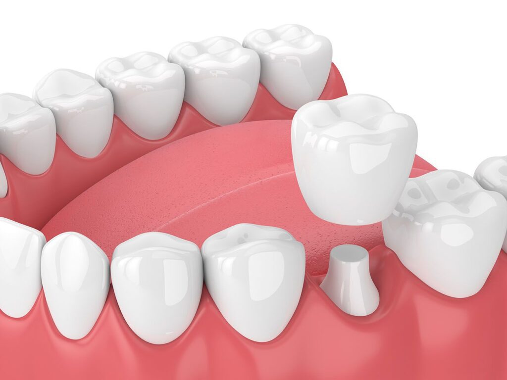 dental crown benefits