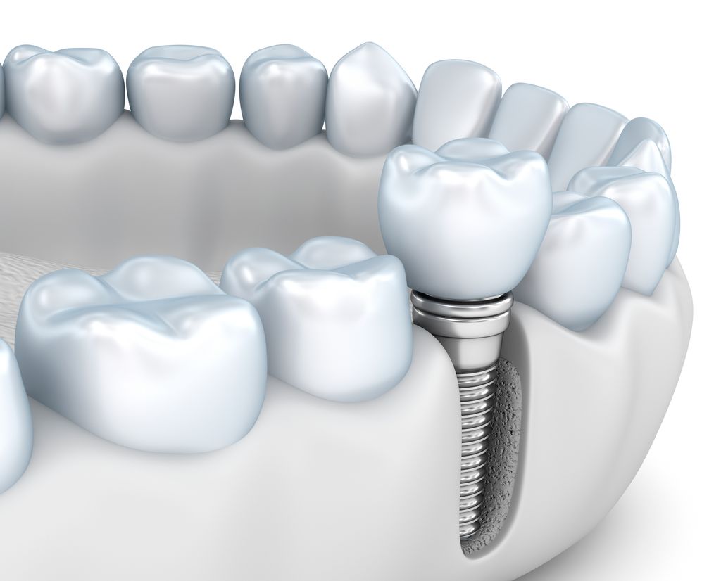 Missing Teeth and Jaw Deterioration