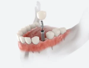 Dental Implants 101: How They Work in Sahuarita, AZ